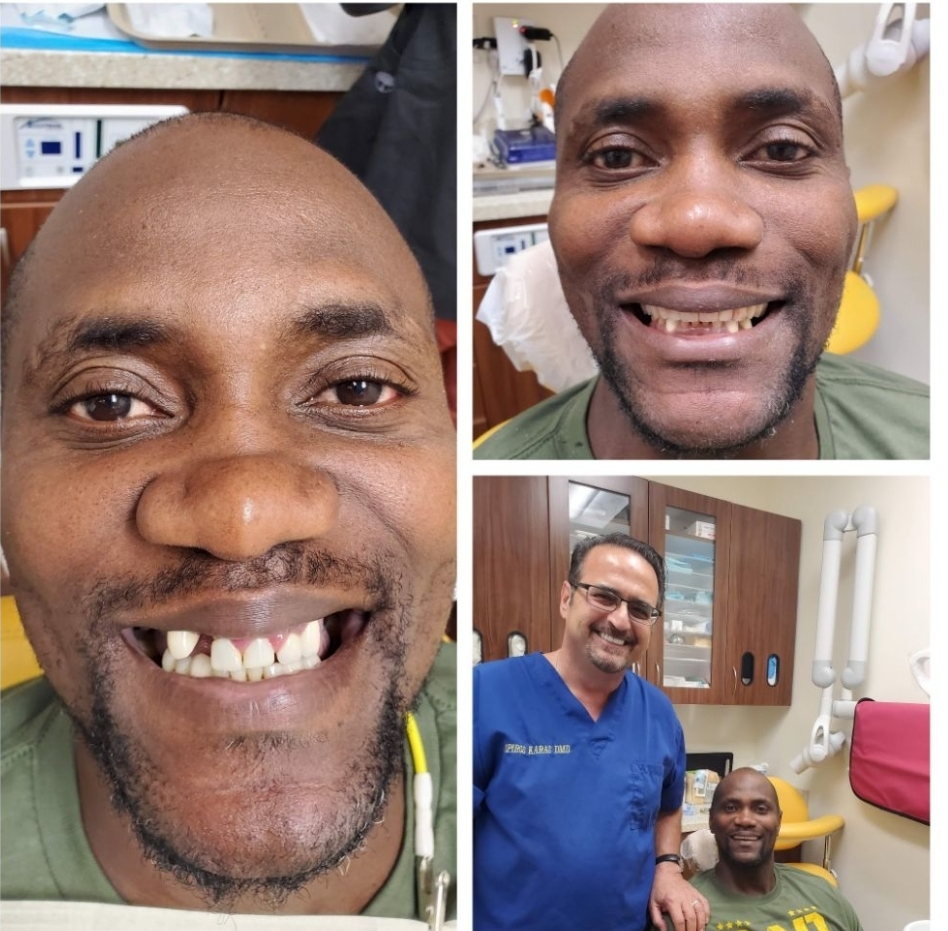 Before and after dental treatment performed by Dr. Spiros Karas at Classic Dental Arts in Manalapan, New Jersey.
