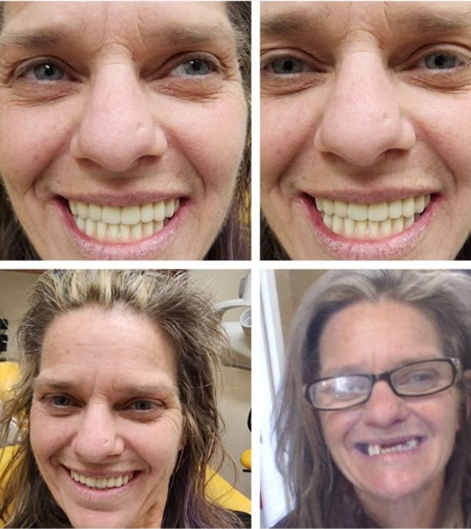 Before and after dental treatment performed by Dr. Spiros Karas at Classic Dental Arts in Manalapan, New Jersey.