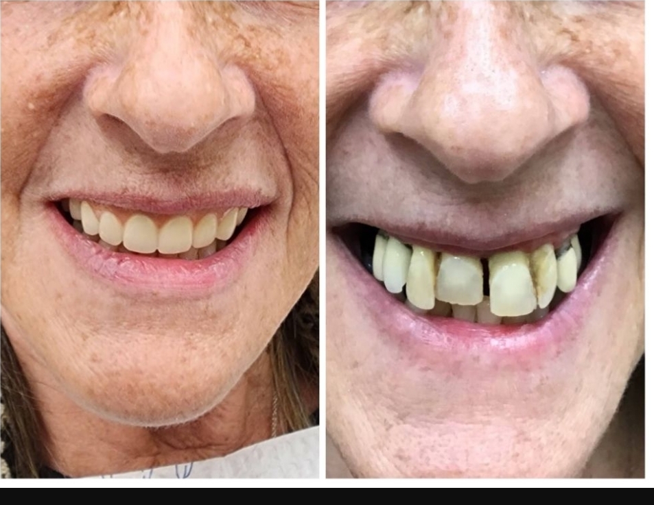 Before and after dental treatment performed by Dr. Spiros Karas at Classic Dental Arts in Manalapan, New Jersey.