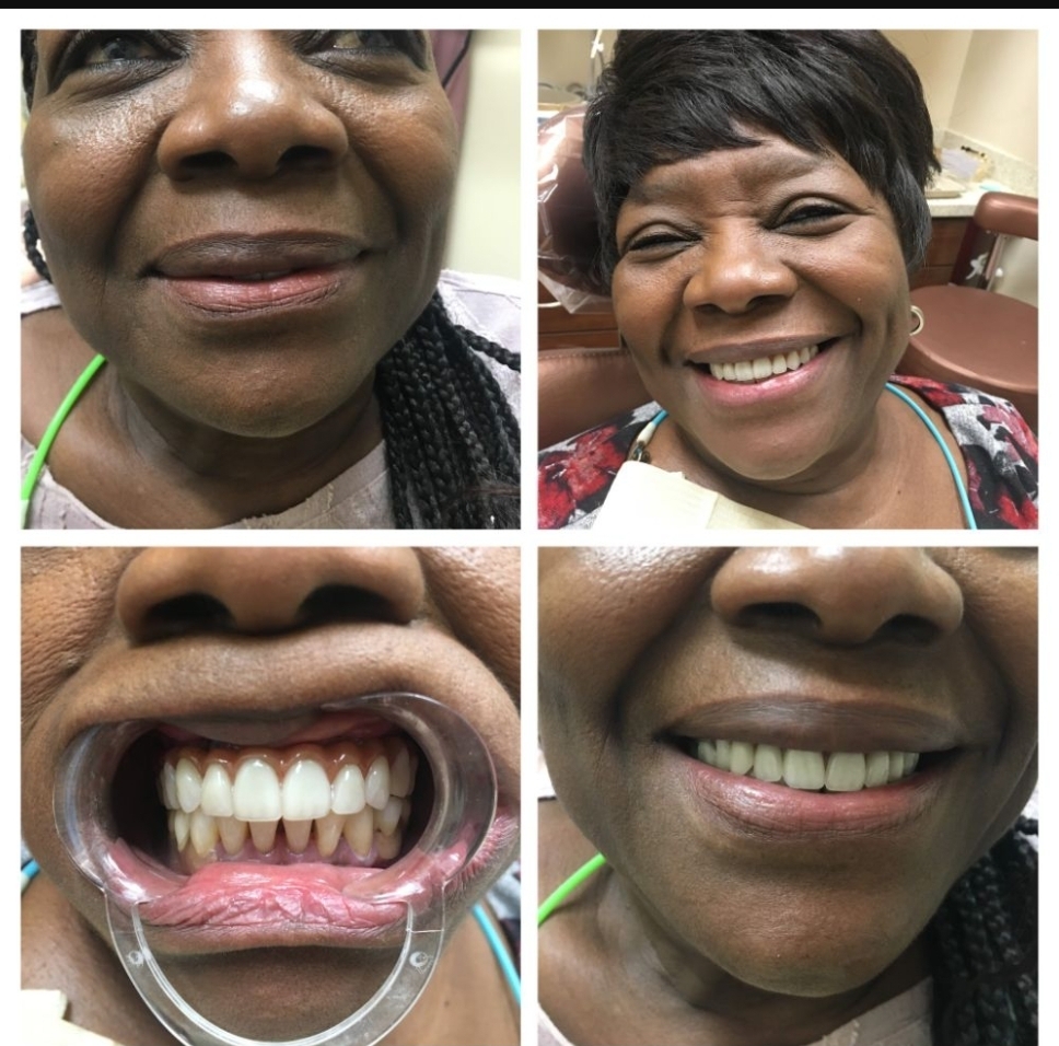 Before and after dental treatment performed by Dr. Spiros Karas at Classic Dental Arts in Manalapan, New Jersey.