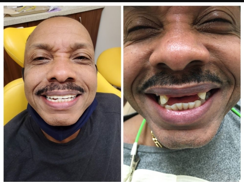 Before and after dental treatment performed by Dr. Spiros Karas at Classic Dental Arts in Manalapan, New Jersey.
